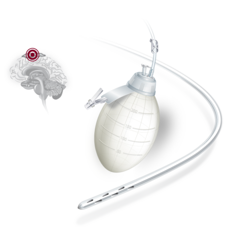 HemaDrain External Surgical Drainage - Hệ thống dẫn lưu ngoại khoa HemaDrain